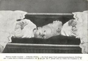 Emilisa Stoll's Siamese (conjoined heads) twin girls, born in Vilbel (fl)