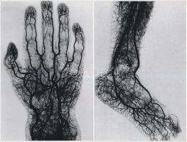 1910 Orvosi röntgen fotók az emberi érrendszerről, 4 db korabeli felvételről készült modern nagyítás...