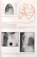 Ifj. Kováts Ferenc - Zsebők Zoltán: A tüdő röntgenanatómiája. Bp., 1959, Akadémiai Kiadó. Kiadói egé...