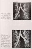 Ifj. Kováts Ferenc - Zsebők Zoltán: A tüdő röntgenanatómiája. Bp., 1959, Akadémiai Kiadó. Kiadói egé...
