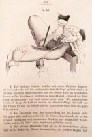 [Friedrich von Esmarch (1823-1908)]: Dr. Friedrich Esmarch: Handbuch der Kriegschirurgischen Technik...