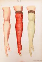 [Friedrich von Esmarch (1823-1908)]: Dr. Friedrich Esmarch: Handbuch der Kriegschirurgischen Technik...