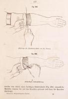 [Friedrich von Esmarch (1823-1908)]: Dr. Friedrich Esmarch: Handbuch der Kriegschirurgischen Technik...
