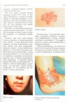 Dr. Török Éva, Dr. Rutkai Krisztina: Gyermekbőrgyógyászat. Bp., 1995, Medicina. Második kiadás. Szín...