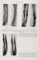 Böhler, Lorenz: Technik der Knochenbruchbehandlung im Frieden und im Kriege, I. Wien, 1941. Wilhelm ...