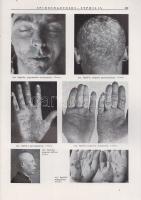 Nékám Lajos (szerk.)
Corpus Iconum Morborum Cutaneorum. Auxilio 568 collaboratorum specialiter erud...