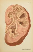 Bollinger O[ttó]: A kórboncztan alapvonalai. Atlaszszal. [A kórboncztan atlasza.] II. köt.: A húgysz...