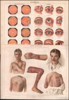 cca 1900 5 db emberi testtel, betegségekkel kapcsolatos melléklet a Pallas Nagy Lexikonából. Javarés...