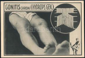 1932 Pöstyénfürdő (Felvidék), Pro Patria Szanatórium által alkalmazott reumatikus iszapkocka kezelés...