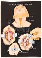 cca 1960 A Gyermek sebészet c. diafilm eredeti, komplett, fényképezett és montázsolt kockái, a gyárt...